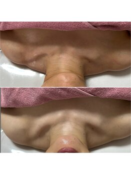 とぅるりん 肌質改善/背中デコルテトリートメント♪