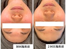 リコス(LICCO’S)/光フォト　シミケア１回