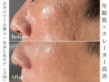 ゼアー(THERE FY.)/10代からの肌悩みにも