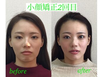 オズ六本木/小顔矯正モニター様2回目施術