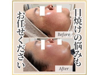 パール(PEARL)の写真/【本気のシミケア】話題の光フェイシャルでシミしわ×はり艶×透明感UP♪