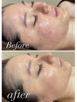 レシェルサロン(Lechelle Salon)/ハーブピーリング