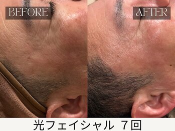 スキンジム(SKIN GYM)/印象を左右する目元のしわ改善