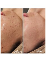 ルオント(LUONTO)/時間がかかるニキビケア