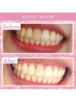 エクシアホワイトニング 高松本店/ホワイトニングビフォーアフター