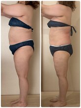 リノ(Lino)/お腹・二の腕も集中ケア