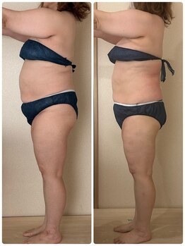 リノ(Lino)/お腹・二の腕も集中ケア