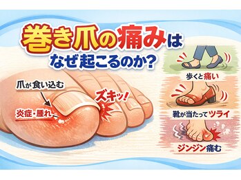 巻き爪じゅん 千葉駅前店/巻き爪の痛みが消える理由とは？