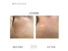 サロン エイトミー(salon 83)/光フェイシャル/before→after