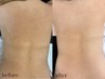 【U24学割】背中上部Wax+毛穴引き締め水光パック