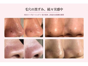 ホワイトアクア 北千住店(WHITE AQUA)の写真/【肌質改善/毛穴ケア/ニキビケア】毛穴も、肌質も。REVIハーブピーリング×毛穴洗浄で根本改善！