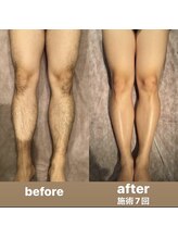 メンズ脱毛 ジョルジオ(GIORGIO)/脚の脱毛　ビフォーアフター7回