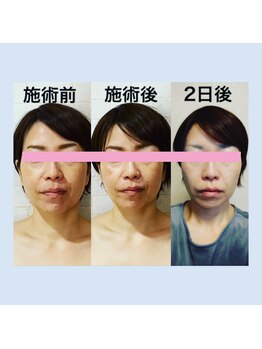 サロンドミジュ(Salon de 美jyu)/小顔・骨格矯正　Y様40代