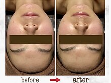 ナチュラーレ 京都四条烏丸店(Naturale)/美肌ニキビケア小顔フェイシャル