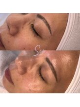 ジュエッテ(jouete)/MTSトリートメント