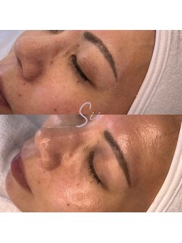 ジュエッテ(jouete)/MTSトリートメント