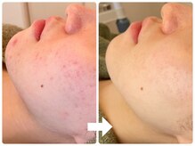 リミー 東大宮店(REME)/【ハーブ】赤みケア