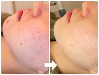 リミー 東大宮店(REME)/【ハーブ】赤みケア