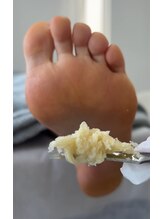 フットミー(foot mii)/かかとの角質ケア