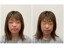 リシュレータ(RISYURE-TA)/美容鍼（before after）