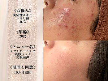 アクール(Accueil)/【ニキビ・跡】