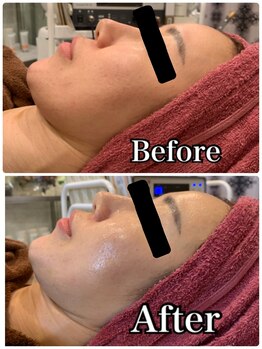 ブランシュール/炭酸カーボキシー×エンビロン