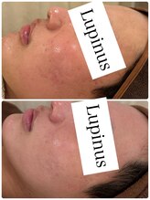 ルピナス(Lupinus)/男性モニター様