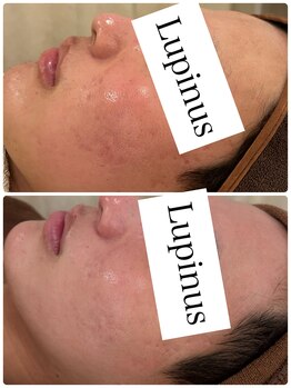 ルピナス(Lupinus)/男性モニター様