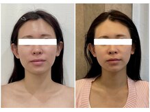 ニコワ(Nicowa)/Nicowaのコルギ★BeforeAfter