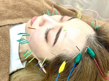 伊藤接骨院の写真/【初回1500円】電気を流す美容鍼でお顔全体の引き上げ、引き締めを実現♪むくみ・肌質改善・眼精疲労にも◎