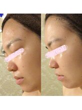 アユアランリンク 札幌店/1カ月でなめらか肌！横向き