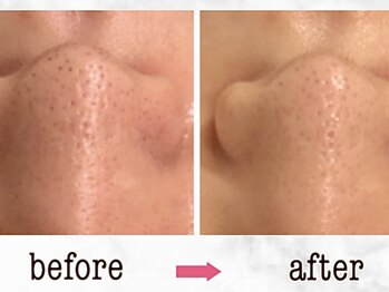 ナチュラーレ 京都四条烏丸店(Naturale)/美肌ニキビケア小顔フェイシャル