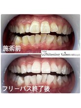 ホワイトニングサロン 京都烏丸店/ホワイトニング施術例