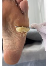 フットミー(foot mii)/かかとケア