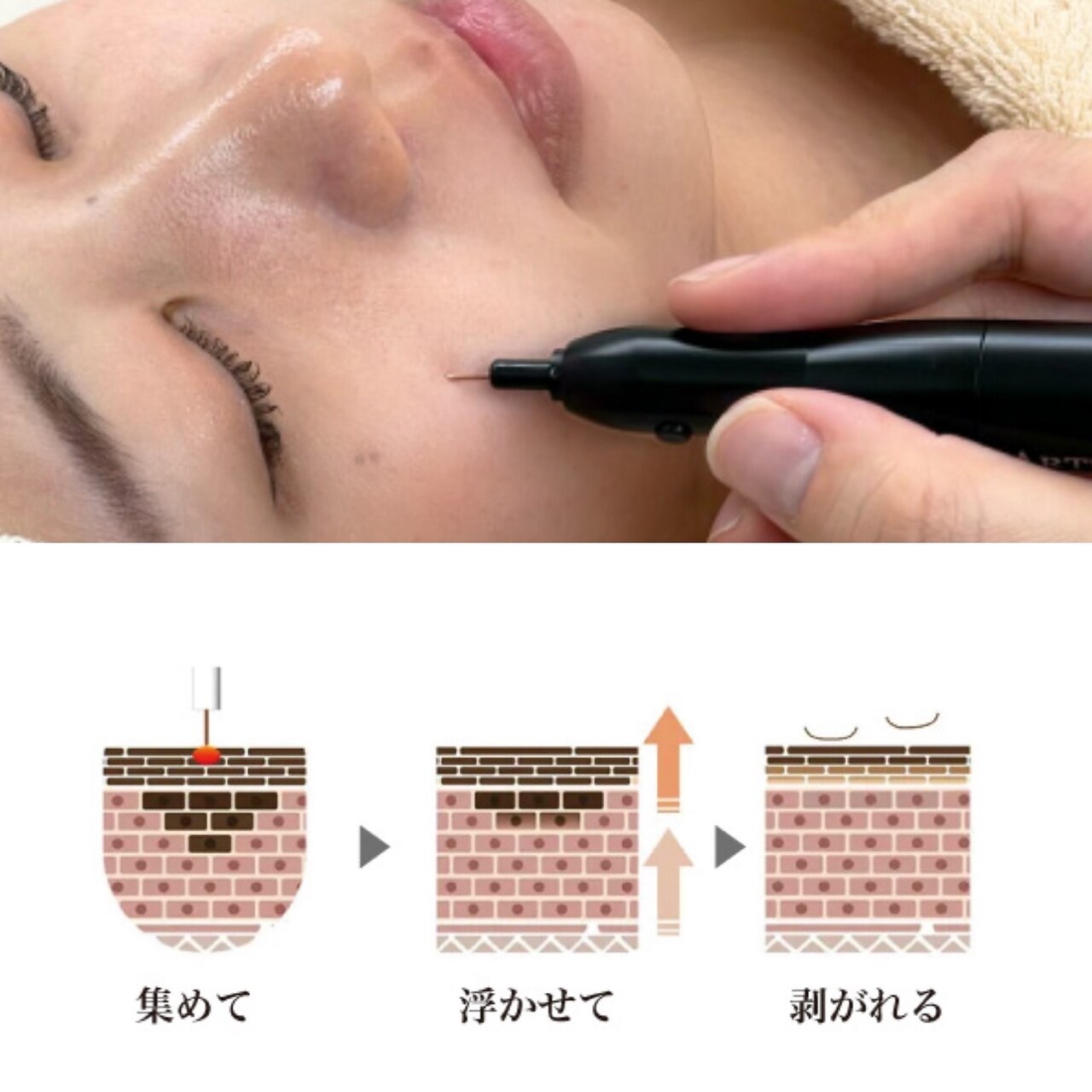 【大人気】　シミケア【感動・実感◎】15分照射　\3500