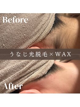 エピナ 千葉店(Epina)/うなじMIX脱毛☆