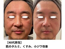 ボニータ(Bonita)/【Lit】ヒト羊膜幹細胞エステ