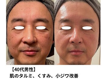 ボニータ(Bonita)/【Lit】ヒト羊膜幹細胞エステ