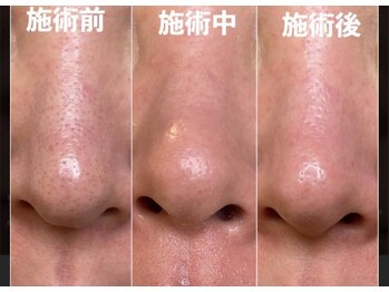 ネイキッド (NaKid)の写真/毛穴スッキリ☆!!穴角栓洗浄吸引
