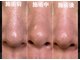ネイキッド (NaKid)の写真/毛穴スッキリ☆!!穴角栓洗浄吸引