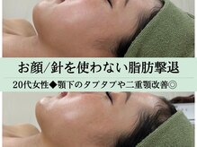 ソルニス(Solnis.)/小顔☆脂肪分解/ハイパーナイフ