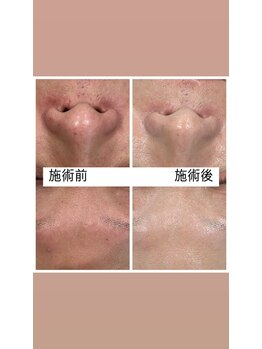 マノ(mano)/復元フェイシャル