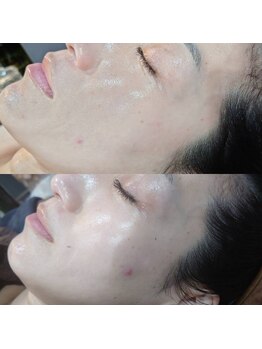 ボーソリューション(Beau-Solution)/【40代　肌質改善】