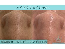 リメイククリニカルビューティー(Remake clinical beauty)/ざらざら毛穴解消