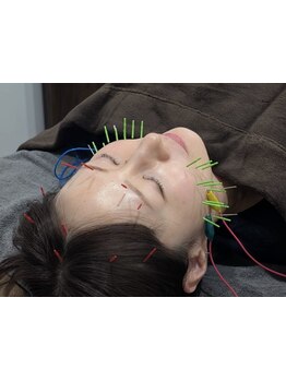 鍼灸施術を受けたい