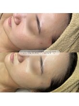 アール(R;)/敏感肌でも施術可能◎