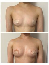 ルナグランデ(Luna grande.)/豊胸なしでこの変化♪3カップ☆