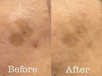 トリンテ バイ フェース(TRINTE by FAITH)/【光フェイシャル】経過写真