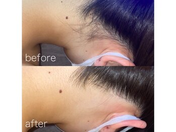 エピジュ(Epijyu)/女性のうなじ脱毛