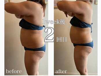 グレイティア(gratia)/上半身痩身